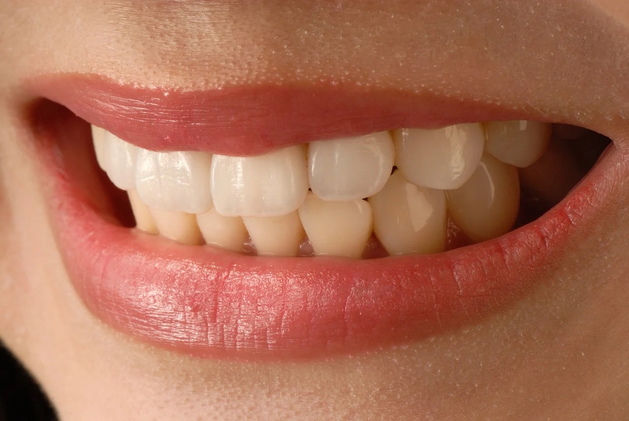 Porcelain veneer