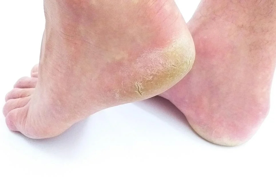 foot pain
